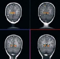 En Estados Unidos estudian el desarrollo cerebral de los niños mediante RM