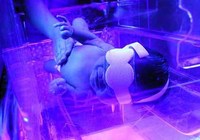 Bililuces: tratamiento para la ictericia