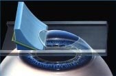 La cirugía ocular LASIK