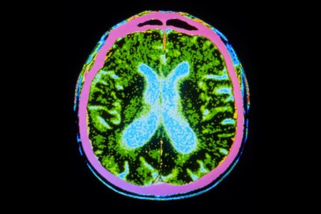 Células cerebrales de cerdo en cerebros de personas con Parkinson