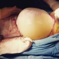 Increíble vídeo de un bebé que nace dentro de la bolsa amniótica por cesárea 