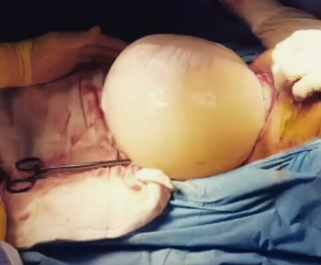 Increíble vídeo de un bebé que nace dentro de la bolsa amniótica por cesárea