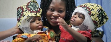 Por primera vez se logra separar con éxito a dos gemelas siamesas unidas por el cráneo y el cerebro en la zona de la nuca