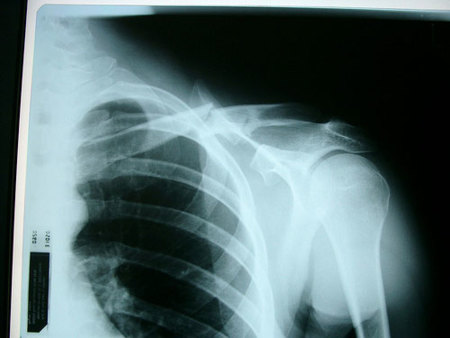Tendinitis calcificada, un mal del manguito rotador