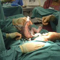 ¿Qué es el prolapso del cordón umbilical y por qué ocurre?