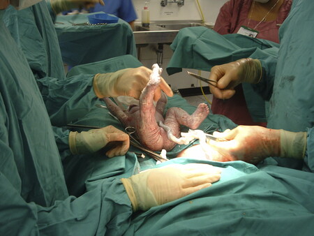 ¿Qué es el prolapso del cordón umbilical y por qué ocurre?