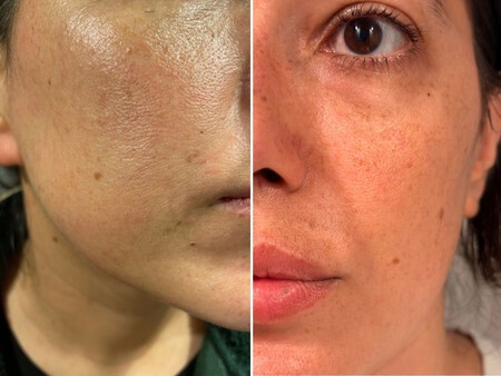Seis Meses Usando Retinol Efectos Y Aspecto De La Piel 10