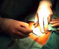 Indemnizan a una familia por una cesárea tardía