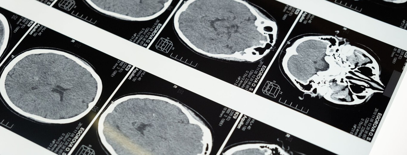 No es solo cuestión de cumplir años: la mala salud metabólica envejece tu cerebro por una vía completamente independiente