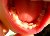 Por dónde salen los dientes definitivos