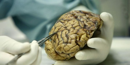 Científicos españoles consiguen frenar el crecimiento del cáncer cerebral más común
