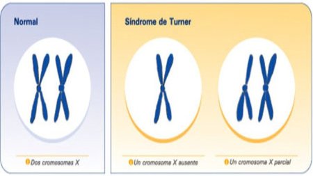 Síndrome de Turner