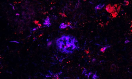 Un anticuerpo elimina las placas de Alzheimer, en ratones