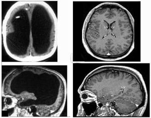 Cerebro pequeño, vida normal