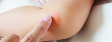 Picaduras de insectos en bebés y niños, ¿qué hacer y cómo prevenirlas?