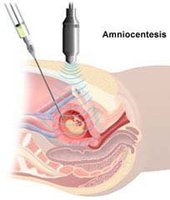 Los riesgos de la amniocentesis
