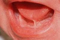 Anquiloglosia y Lactancia