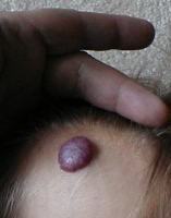 Hallan una posible causa de los hemangiomas