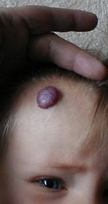 Hallan una posible causa de los hemangiomas