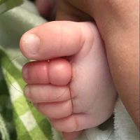 Una madre alerta sobre el "síndrome de torniquete" después que su bebé estuviera a punto de perder los dedos del pie