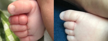 Una madre alerta sobre el "síndrome de torniquete" después que su bebé estuviera a punto de perder los dedos del pie