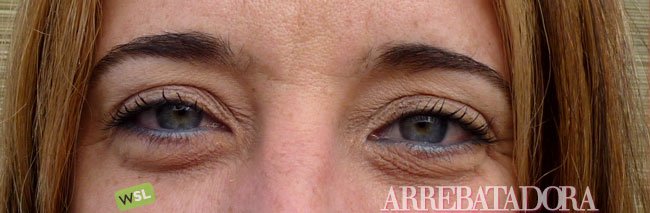 Como librarse de las ojeras si esto es crónico