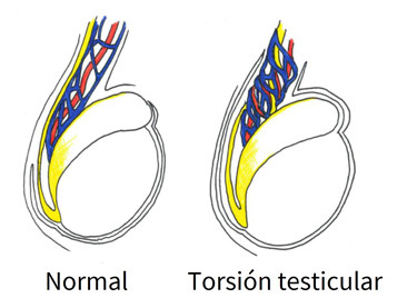 torsion testicular