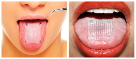 Coserse la lengua para adelgazar: la peligrosa dieta de moda para bajar de peso en tiempo récord