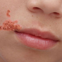 Brote de impétigo en escuelas de Barcelona: todo sobre esta infección cutánea muy contagiosa