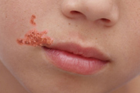 Brote de impétigo en escuelas de Barcelona: todo sobre esta infección cutánea muy contagiosa