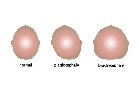 plagiocefalia