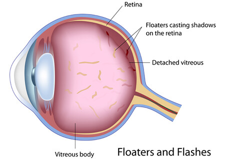 Flashes And Floaters