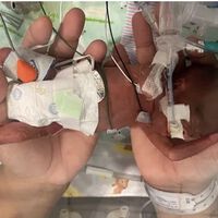 Nació con 21 semanas y pesó 420 gramos: es el bebé más prematuro del mundo que logra sobrevivir según los Récords Guinness 