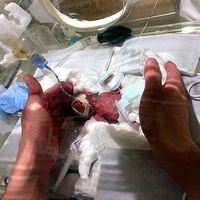 El niño prematuro más pequeño del mundo, que nació con 268 gramos, ha logrado sobrevivir y se va a casa