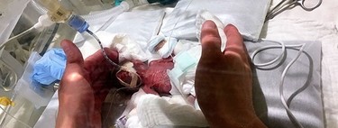 El niño prematuro más pequeño del mundo, que nació con 268 gramos, ha logrado sobrevivir y se va a casa