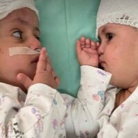 Dos hermanas siamesas unidas por la parte posterior de la cabeza son separadas con éxito en Israel  