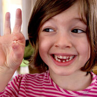 Caída prematura de un diente de leche: por qué ocurre y qué consecuencias puede tener para el desarrollo bucodental del niño
