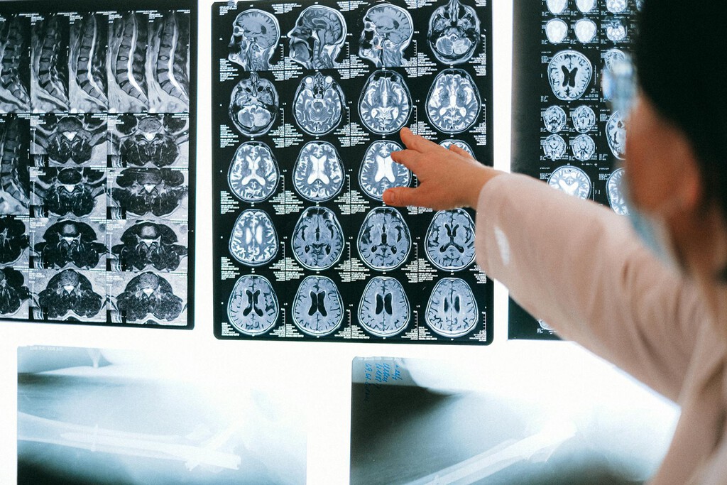 Los ictus se han convertido un enorme problema de salud silencioso en España. Y hay formas de limitar los riesgos