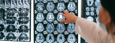 No podemos predecir un ictus, pero podemos evitar sus principales factores de riesgo: reducir el peligro está en nuestra mano