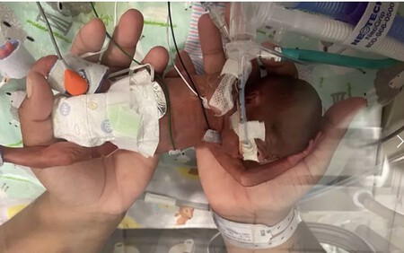 Nació con 21 semanas y pesó 420 gramos: es el bebé más prematuro del mundo que logra sobrevivir según los Récords Guinness