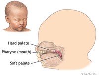 Identifican la primera variante genética asociada con el labio leporino