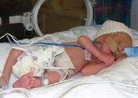 Los respiradores mecánicos en bebés muy prematuros pueden desarrollar daños en los pulmones