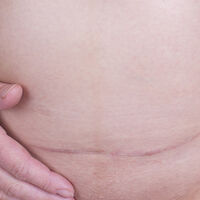 13 consecuencias de la cesárea que nadie te cuenta y debes conocer