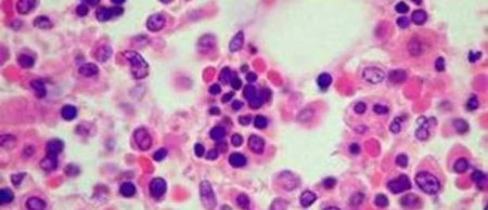 Se ha conseguido secuenciar el genoma de la leucemia