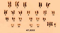 47, XXX. Trisomía genética sexual en hembras