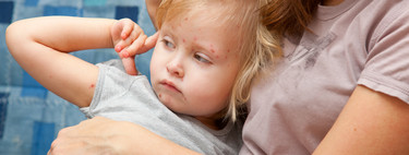 No vacunó a su hijo contra la varicela, y tras las graves consecuencias sufridas por la enfermedad, quiere alertar a otros padres