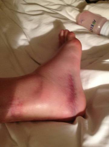 Las secuelas de los accidentes de Casey Stoner, Nicky Hayden y Héctor Faubel