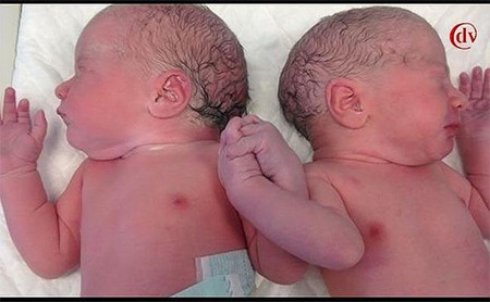 Unos mellizos que se dieron la mano al nacer emocionan a un hospital entero