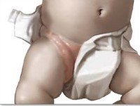 La dermatitis del pañal