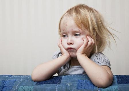 Una niña de 3 años muere a causa del virus de la varicela
